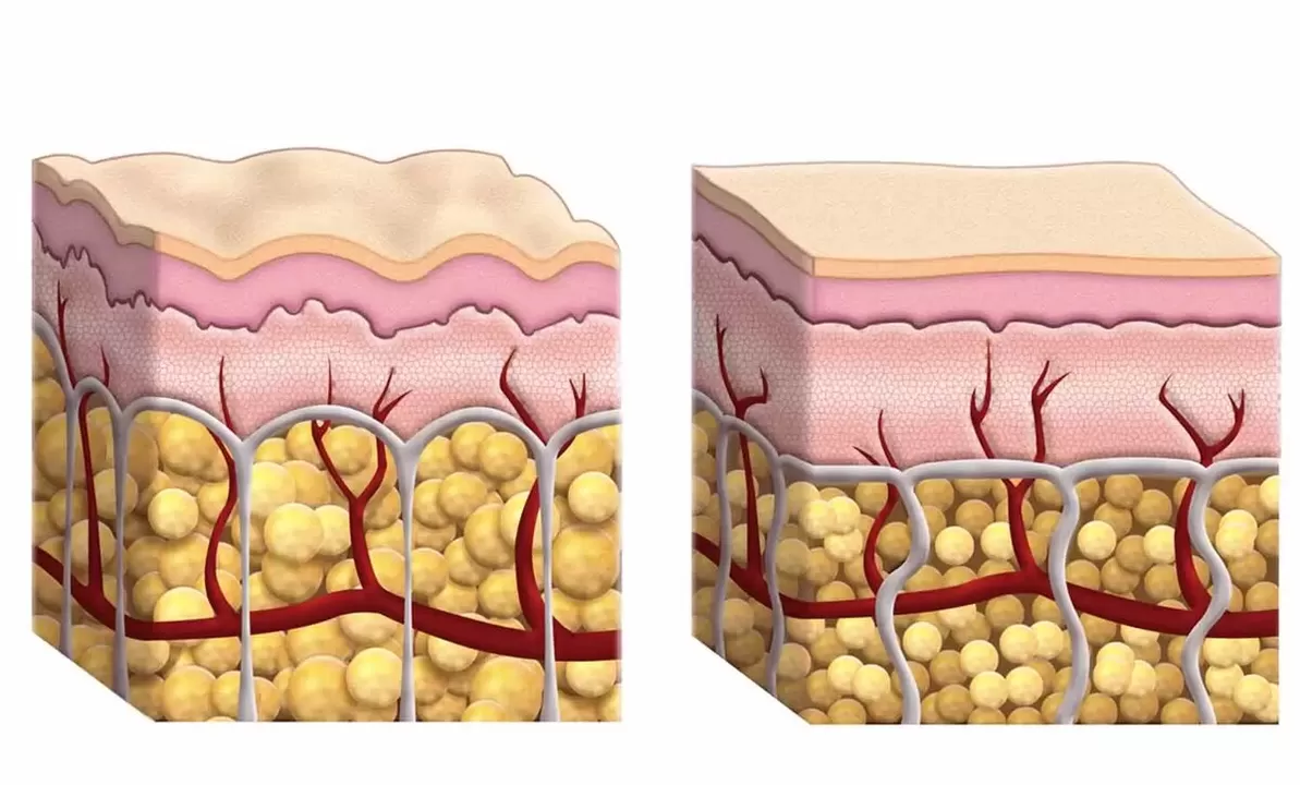 Cellule adipose durante l'utilizzo di keto -guru